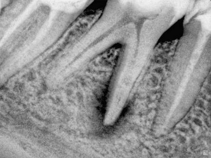 Cauzele periodontita cronica, simptome, stadii, prevenirea