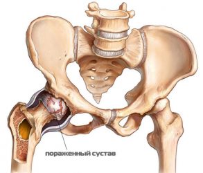 Хрускіт в тазостегновому суглобі причини болю