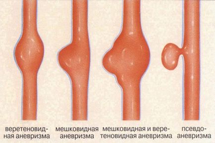 Anevrismul arterei carotide - cauze, simptome și tratament