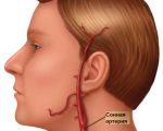 Anevrismul arterei carotide - cauze, simptome și tratament