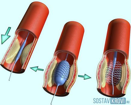 Aneurysm az arteria carotis a nyak, okok, tünetek, kezelés, műtét, diagnosztizálására és megelőzésére