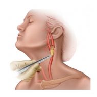 Anevrismul arterei carotide (vaselor gâtului) de tratament, simptome