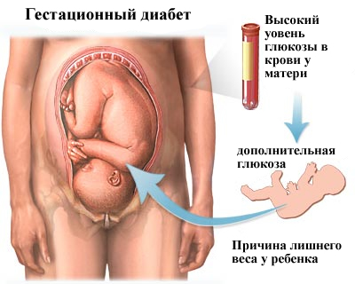 terhességi diabétesz jelei