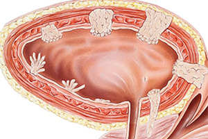 Simptomele polipilor, tratament, ce să facă în vezica biliară