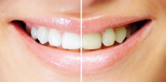 Боядисване на стоматологични зъби боя - бяла усмивка в минути