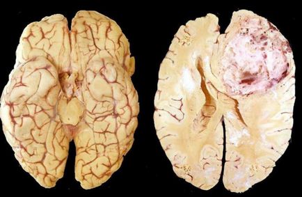 Tumorile cerebrale - clasificarea în funcție de tipul histologic, de Smirnov, localizare