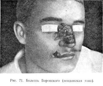 Pendinskaya ulcer (boala lui Bohr)