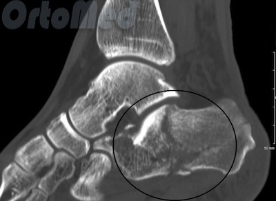 Fractura simptomelor toc, tratament, chirurgie, reabilitare, ipsos în fracturile de calcaneu