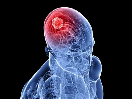 Tipuri de tumori cerebrale și specii de clasificare