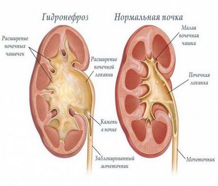 rinichii Pyelectasia dreapta și la stânga că este