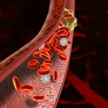 Retina artéria embólia tünetek, diagnózis és kezelés