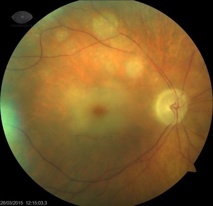 Retina artéria embólia, a tüneteket, megelőzésére, kezelésére embólia