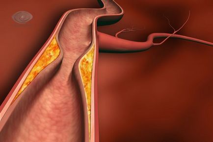 Retina artéria embólia, a tüneteket, megelőzésére, kezelésére embólia