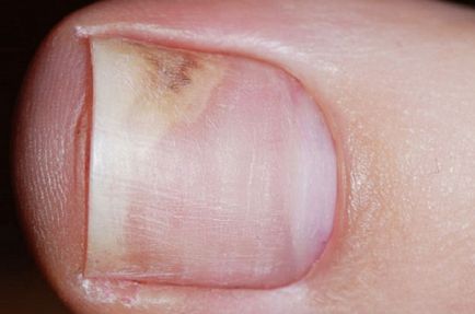 gombák a körmöken kezek és lábak nail gomba a lábát az ok és a kezelés