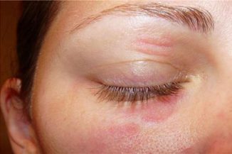 Alergia a pleoapelor si tratamentul ochilor cauze, unguente, picături, umflate, umflate, roșu