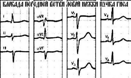 ECG bloc de ramură - simptome și efecte, tratamentul la domiciliu