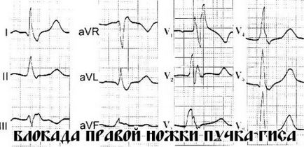 ECG bloc de ramură - simptome și efecte, tratamentul la domiciliu