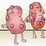 Cistocel sau prolapsul vezicii urinare ca să dea viață nouă organismului