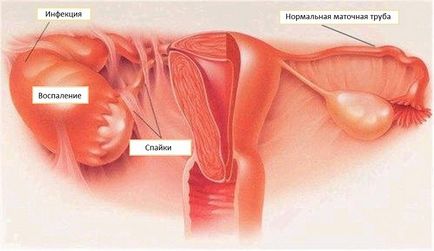 Piosalpinks oldalas, a kezelés, a tünetek, diagnózis