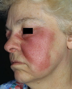 Rozsa - simptomele și tratamentul bolilor infecțioase ale pielii