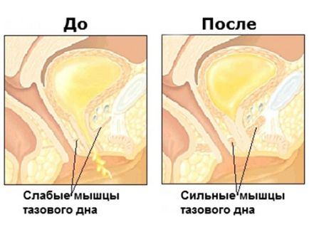 un set de exerciții pentru prostatita cronică)