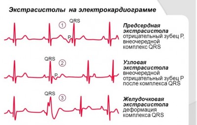 Aritmie sinusală a inimii cauze, simptome, tratament