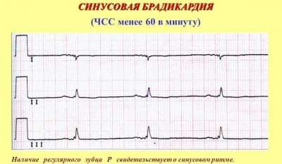 Aritmie sinusală a inimii cauze, simptome, tratament