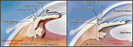 Hogyan kezelésére a nyílt zugú glaukóma, a szem betegség mintegy
