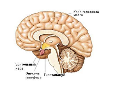 edem cerebral la simptome nou-născuți și efecte