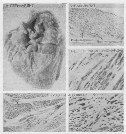 Szívbillentyű betegség - a dinamika a kardiovaszkuláris rendszer