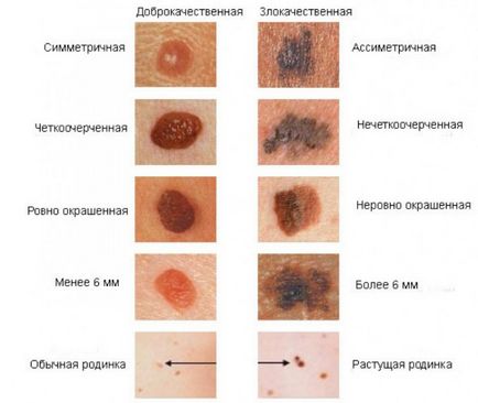 рак на кожата симптоми и признаци със снимки, видове, етапи и лечение