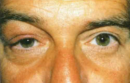 Dacryoadenitis acută (inflamarea glandelor lacrimale), dakrioadenita tratament