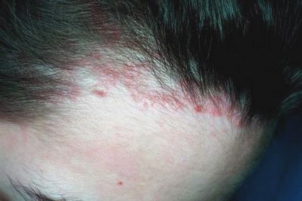 Алергии от бои за коса - симптоми, лечение, снимки