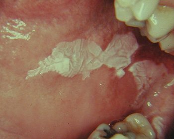 Leukoplakia - лечение на левкоплакия
