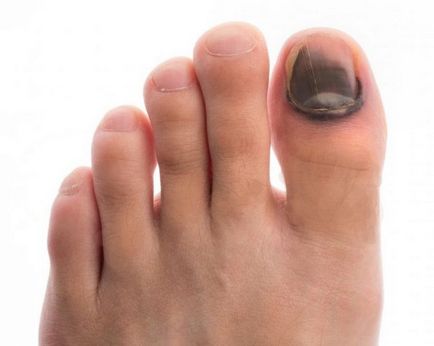 Сините нокти на краката, които правят, лечение