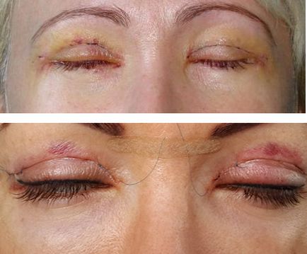 Szemhéj műtét utáni látás, Alsó és felső szemhéjkorrekció