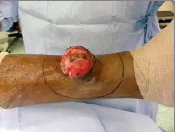 Dermatofibrosarcomul protuberanțe fotografie, tratament, prognostic