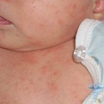 Alergia la nou-născuți cauze, simptome, tratament, și fotografii