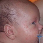 Alergia la nou-născuți cauze, simptome, tratament, și fotografii