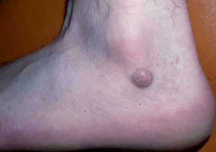 Dermatofibrom pielii care este provoacă, tratarea și eliminarea picior cu laser