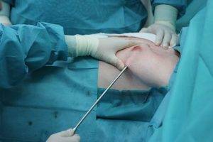 Operațiunea de a elimina ginecomastie la barbati, tratament inainte si dupa interventia chirurgicala de chirurgi din plastic