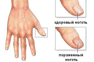 a kezelés gomba a köröm alatt a kezét