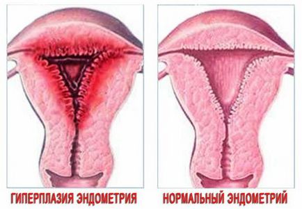 Hiperplazia si polipi, cura de cancer endometrial, răzuire endometrioza