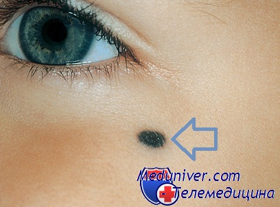 Albastru nevus - diagnostic, tratament