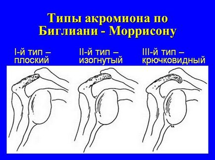 umăr sindromul comun impingement, traumatică pentru toți