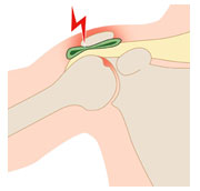 Tratamentul durerii în articulația umărului - sfaturi, Traumatologie și Ortopedie de specialitate la