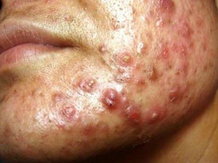 Rosacea fényképet bőr, tünetek, okok és kezelés a betegség