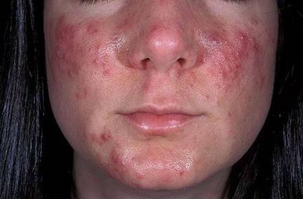 Rosacea fényképet bőr, tünetek, okok és kezelés a betegség