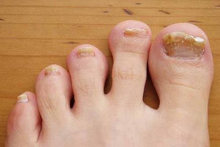 ecet alkohol glicerin körömgombából gomba nail foot futó kezelése