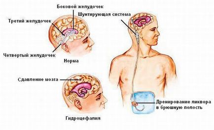 hidrocefalie creier simptomelor copii, tratamentul și posibilele consecințe